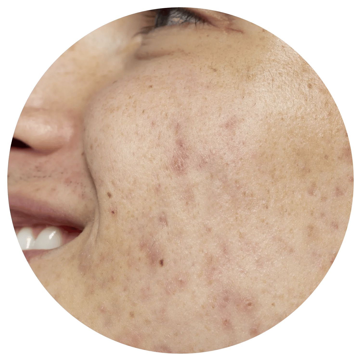 Acne Scarring treatment process at Toronto medical spa - Not all scars are the same—neither are our strategies.